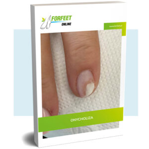 Ebook: Terapia Onycholizy